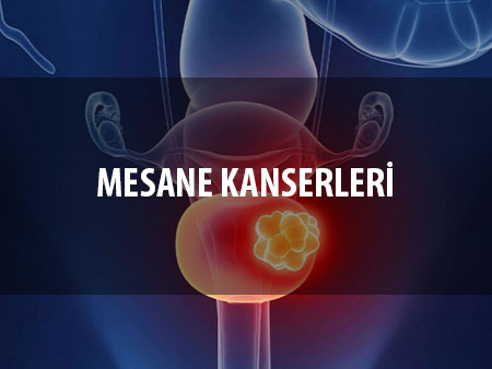 Mesane Kanserleri